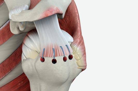 Rotator Cuff Repair